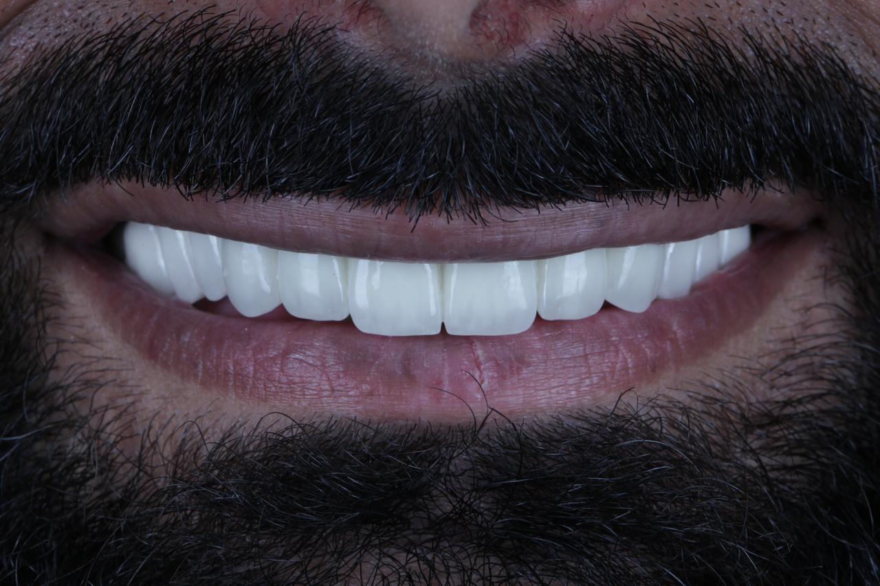 Full Mouth Rehab After