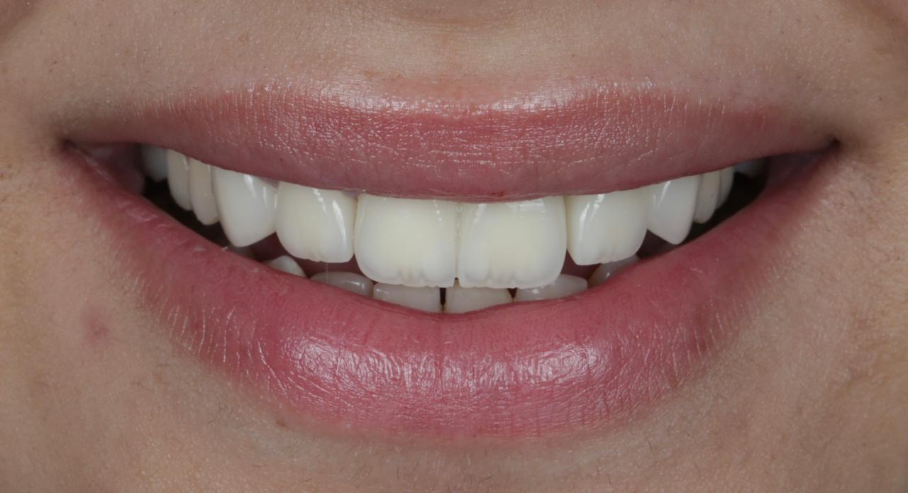 Full Mouth Rehab After