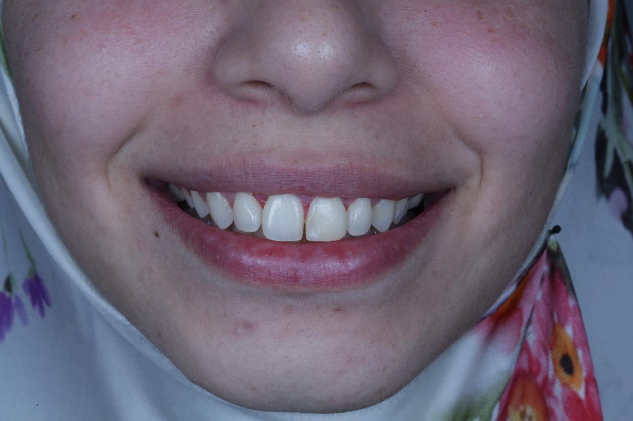 Crown Lengthening After