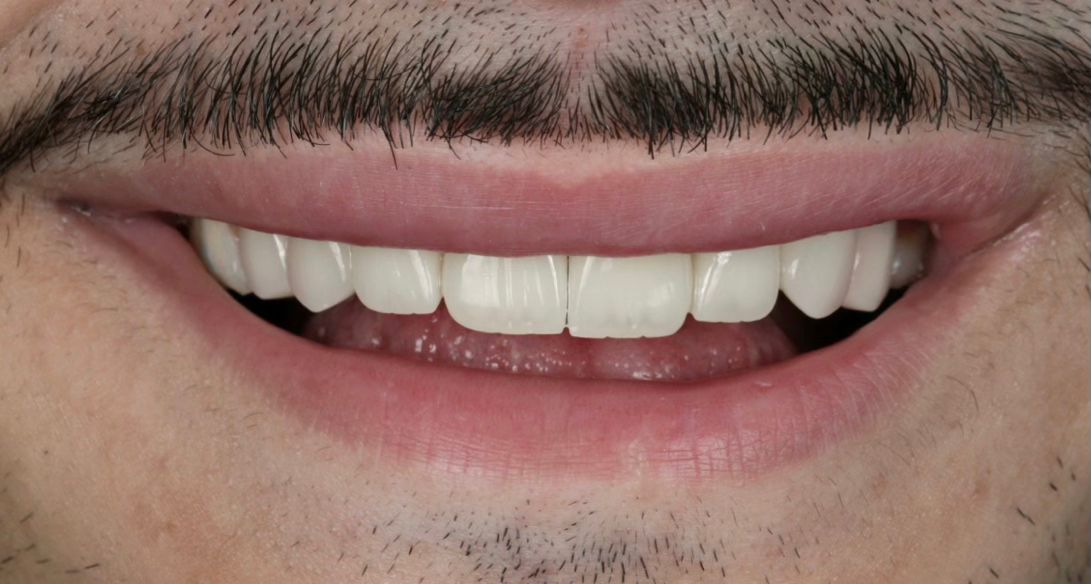 Veneers After