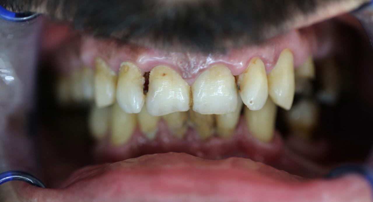 Full Mouth Rehab Before