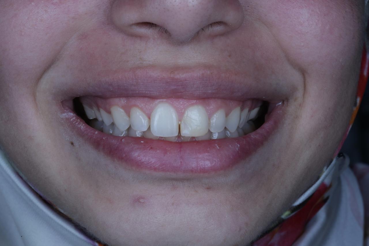 Crown Lengthening Before