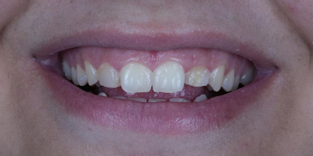 Full Mouth Rehab Before